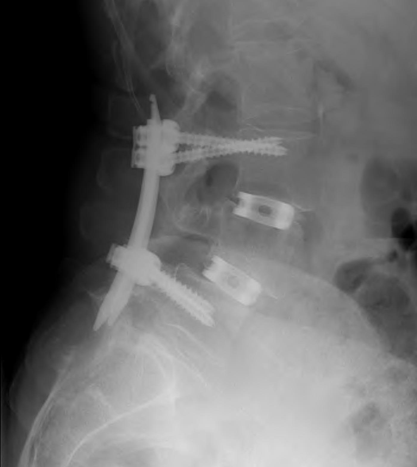 Adult Spondylithesis PLIF